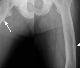 Radiographie de jambes présentant des pseudo-fractures